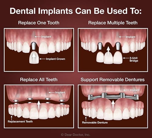 Dental Implants