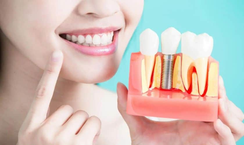 What Are The Amazing Benefits Of Dental Implants
