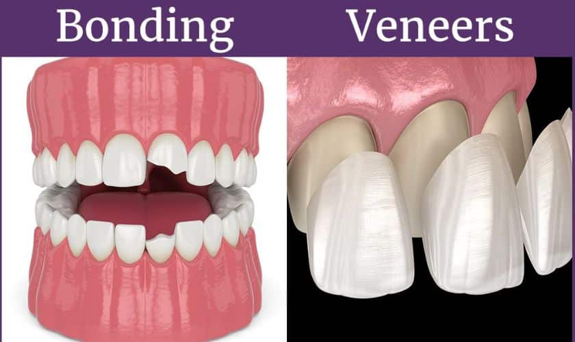 How to decide Dental Veneers or Dental Bonding