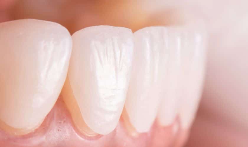 How To Get Porcelain Veneers Over Dental Fillings