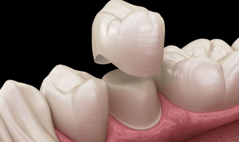 Solving a Dental Dilemma: How Long Does A Same Day Dental Crown Last?
