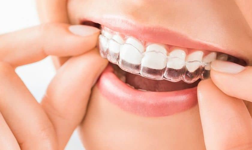 A Comprehensive Guide To Taking Care Of Your Invisalign