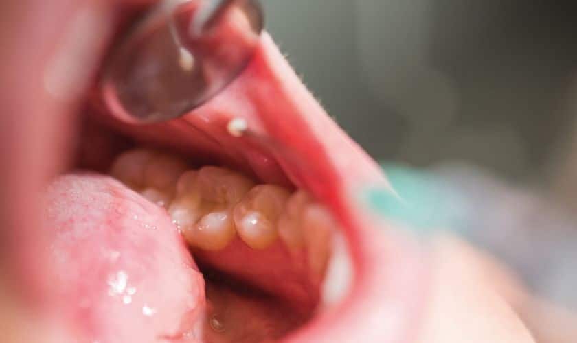 3 Top Reasons Why Doctors Screen For Oral Cancer
