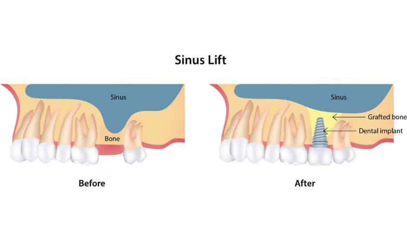 Everything You Need to Know about Sinus Lift Before Dental Implants