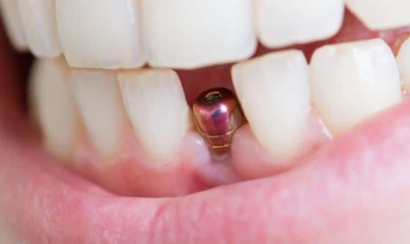 6 Reasons Why Dental Implants are Right for You