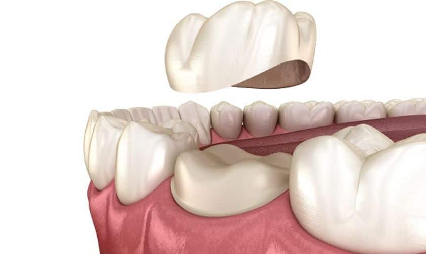 Efficiency and Convenience: Exploring Dental Crowns in a Day