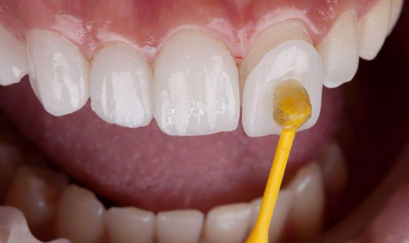How to Care for Your Veneers: Tips from a Dentist