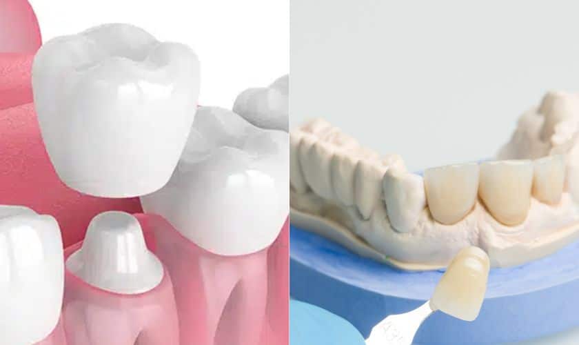 How Are Ceramic Crowns Different From Other Types of Dental Crowns?