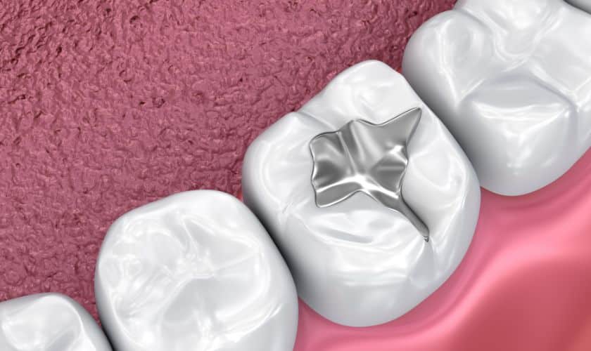 Preserving New Haven Smiles: The Power of Dental Sealants
