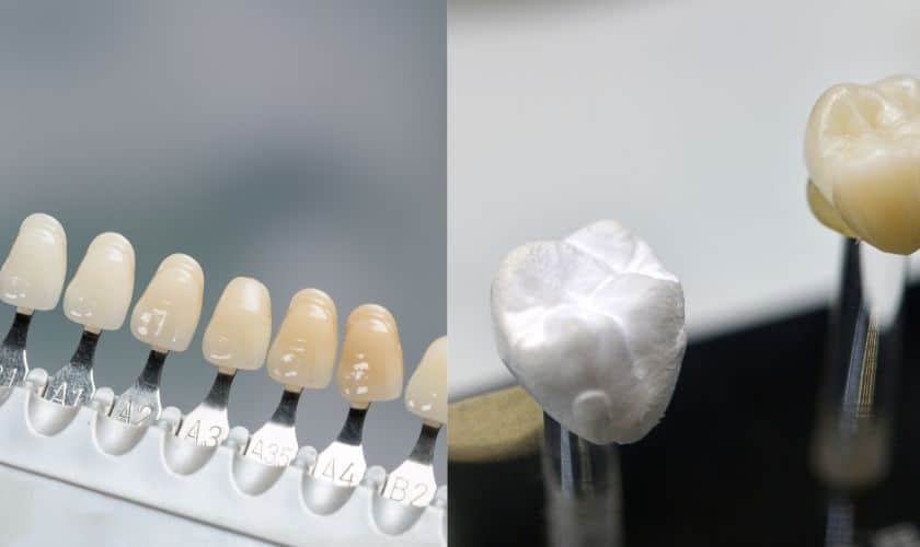 Veneers vs. Crowns: Choosing the Right Option for Your Smile Makeover