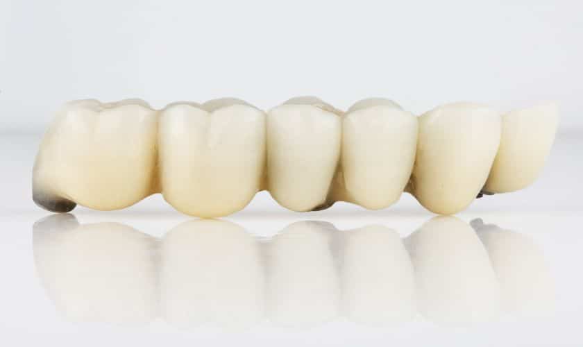 Bridging the Gap: The Benefits of Dental Bridges for a Healthy Smile