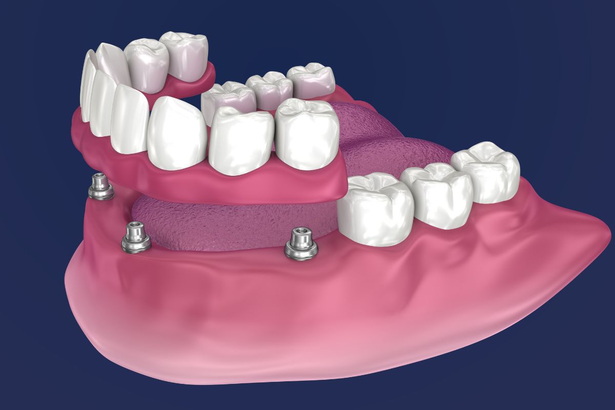 How All-on-4 Implants Can Restore Your Smile