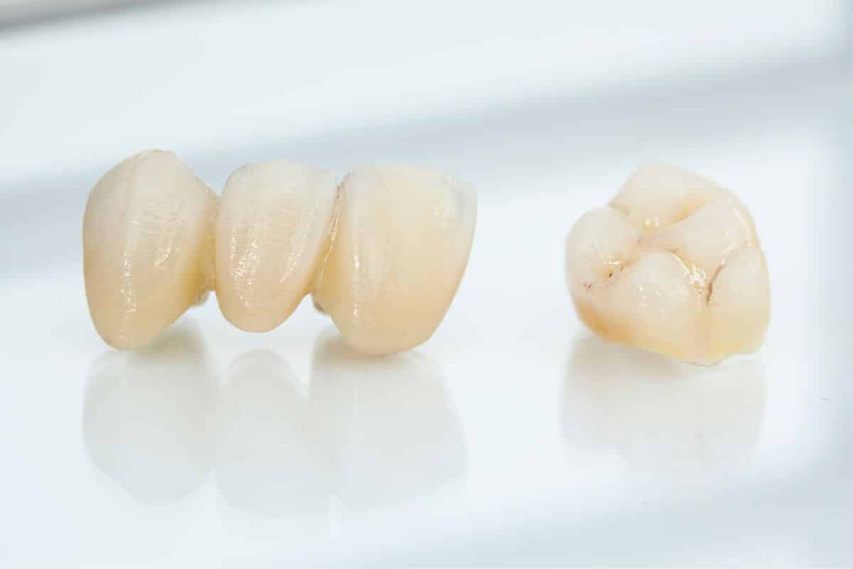 Are Ceramic Crowns More Comfortable Than Metal Crowns? Find Out Here
