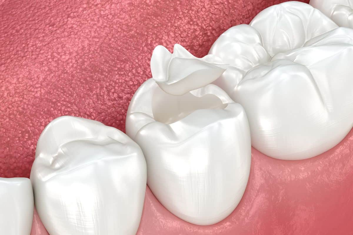 Are Dental Sealants Right for You? A Guide to Cavity Prevention