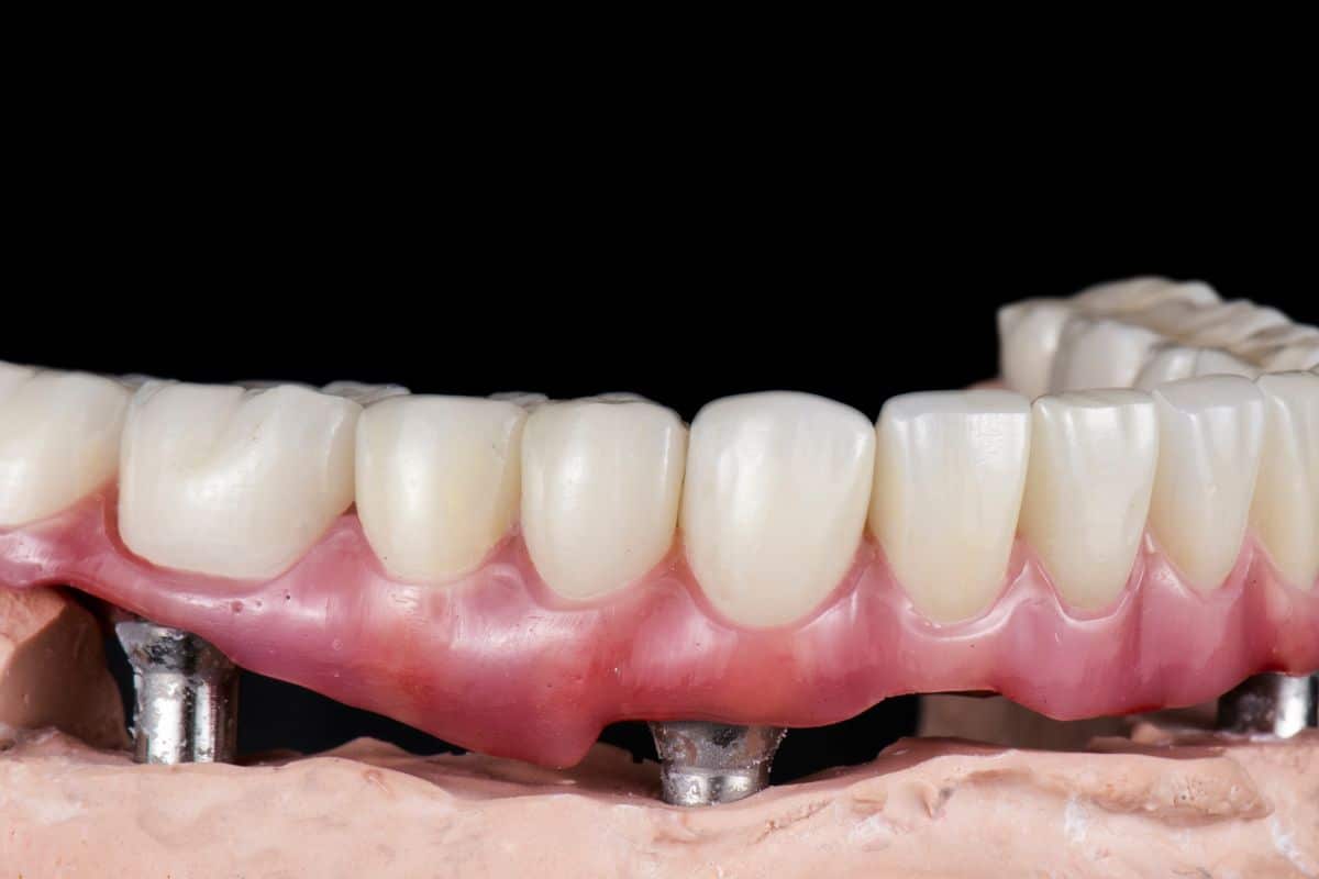 Are You a Good Candidate for All-on-4®?
