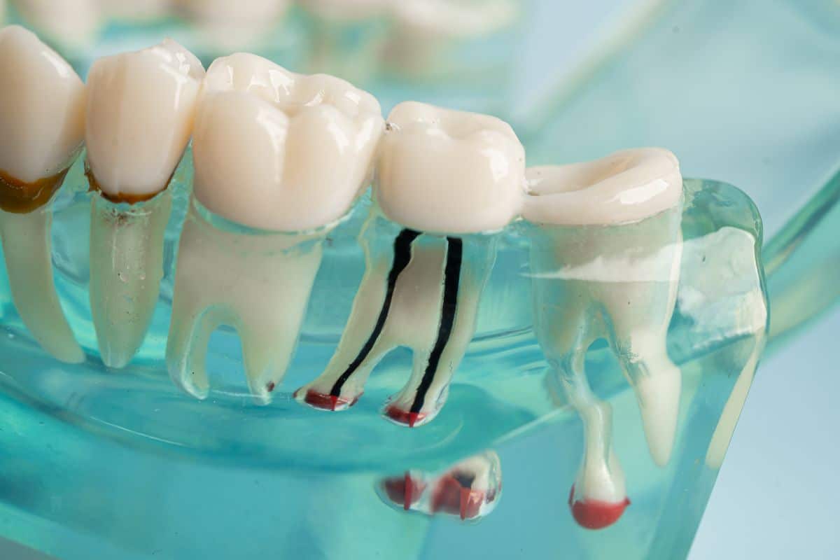 Is Tooth Canal Treatment Painful?