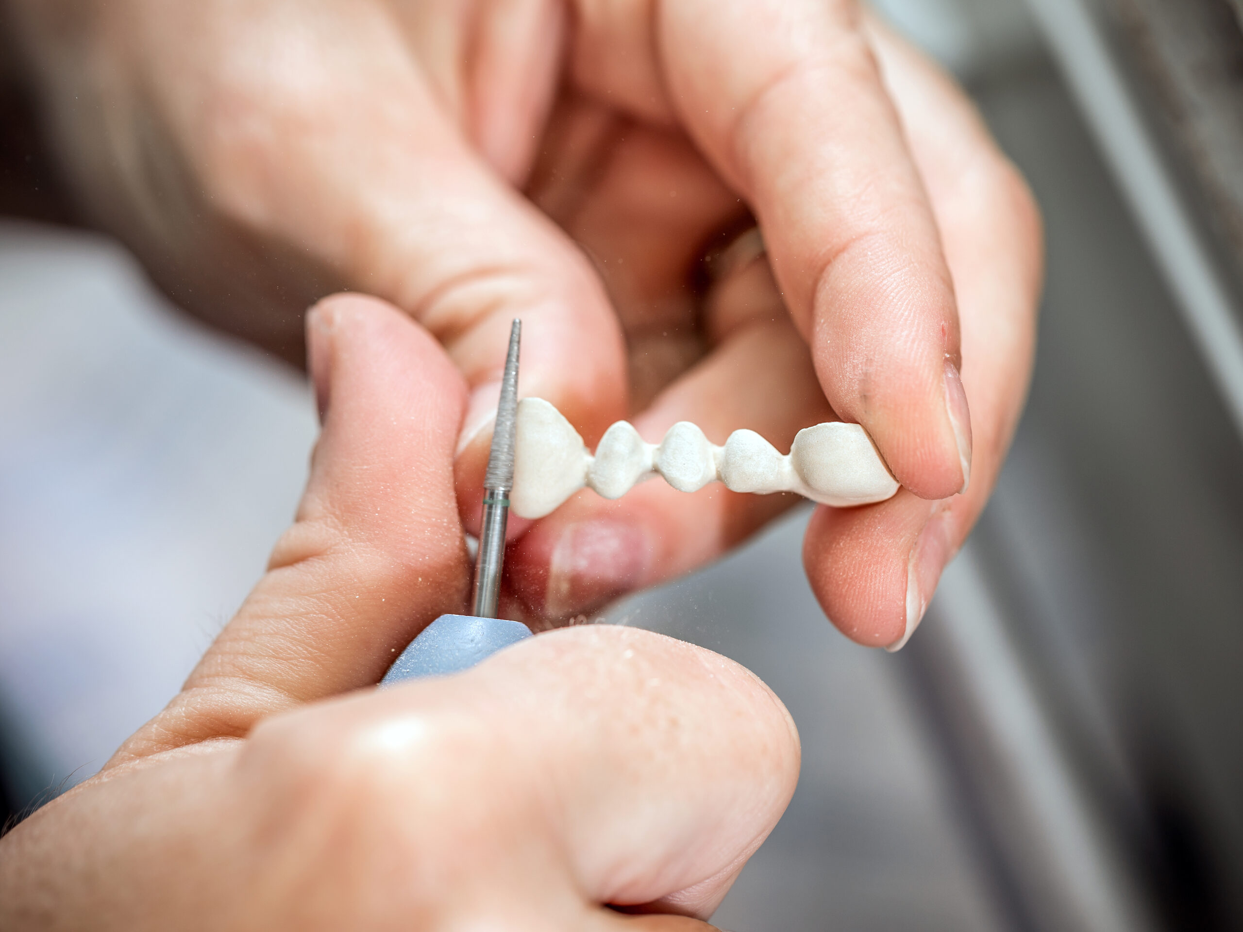 How Our Dentist Provides Crowns in a Day Using Advanced Technology